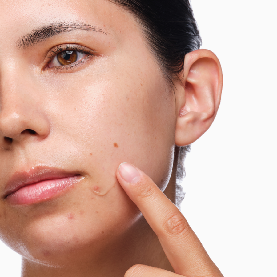 the-acne-set-d5 rdn-the-acne-set-application.png