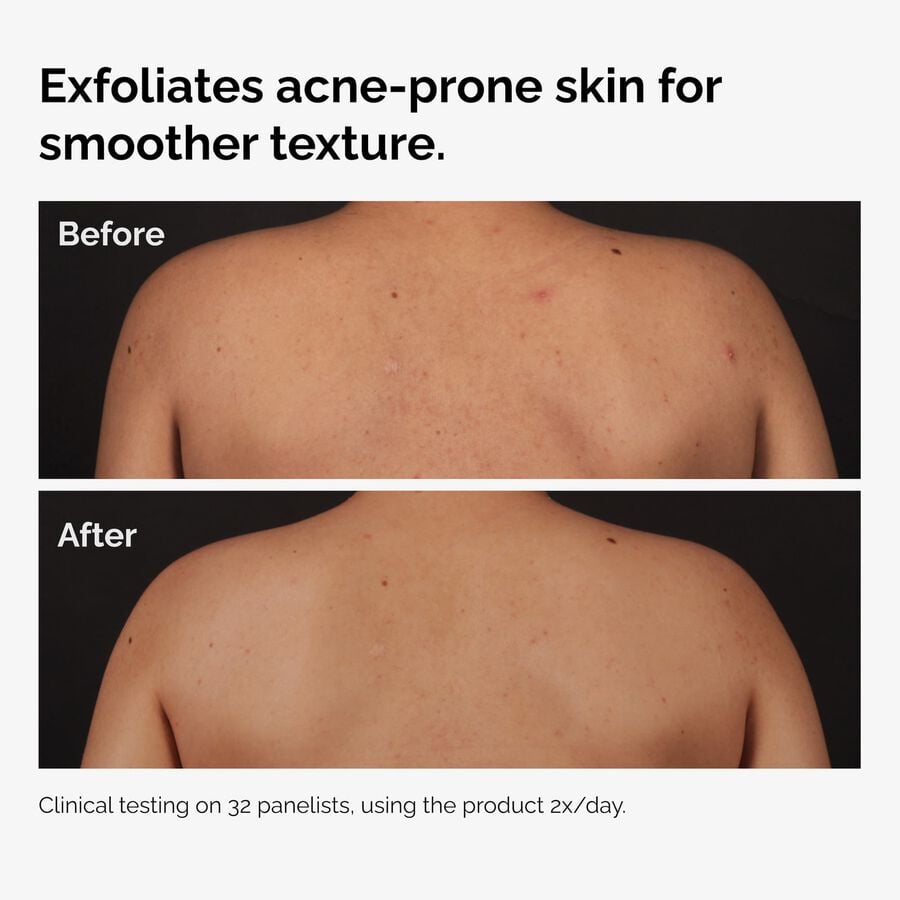 the-body-care-collection-w5 ord-salicylic-acid-body-serum-before-after-graphic-NA.jpg