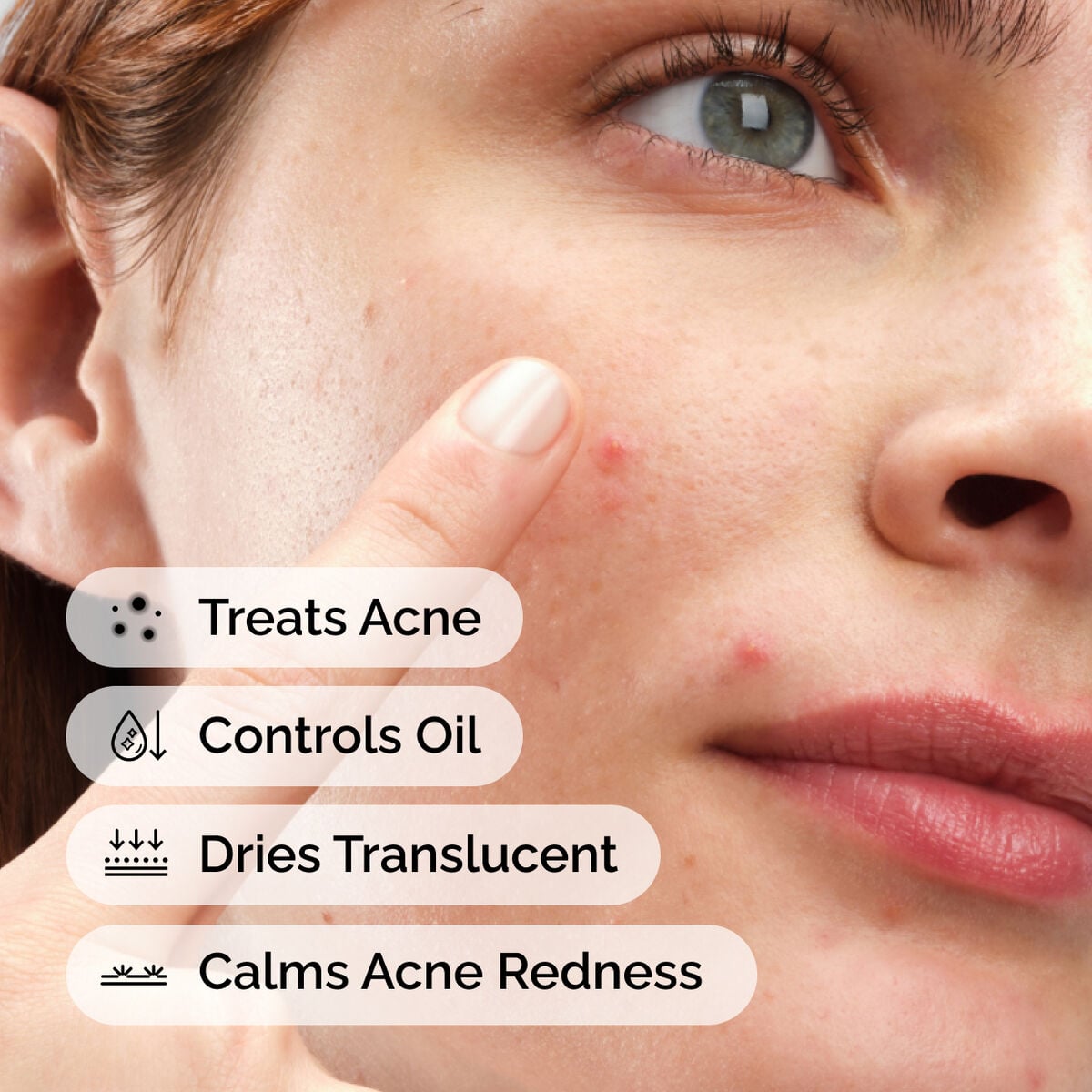 sulfur-10-powder-to-cream-concentrate-t8 ord-sulfur-10pct-powder-to-cream-concentrate-model-application-with-benefits-acne.jpg